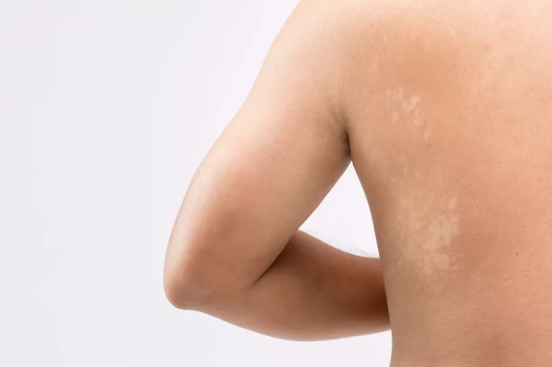 Applying a topical tinea versicolor cream to affected skin