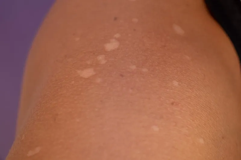 Using an antifungal shampoo for tinea versicolor treatment