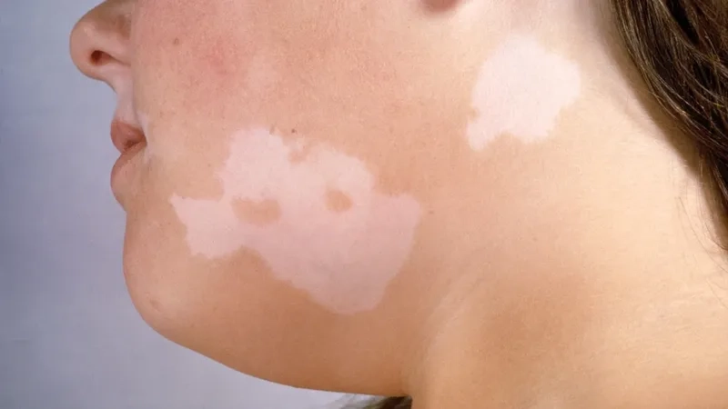 Clarifying why tinea versicolor is not typically contagious