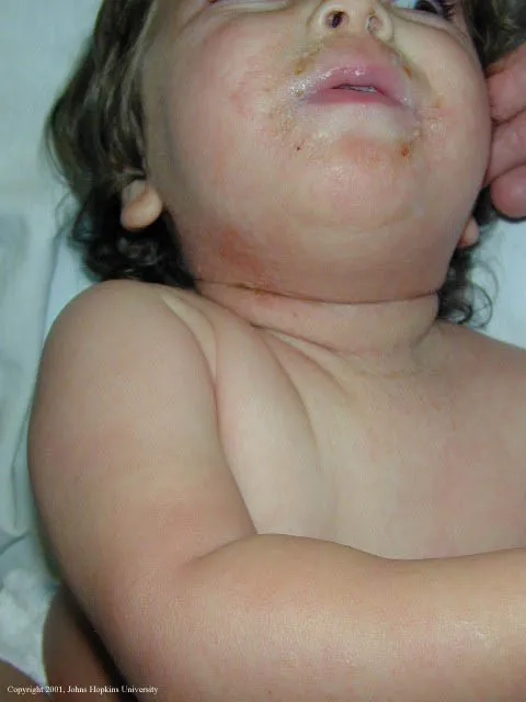 Comparing pneumonia & Legionnaires' disease symptoms