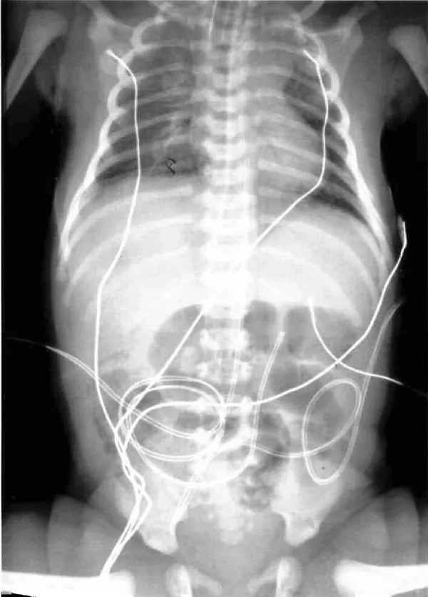 Chart: how common is pneumococcal disease