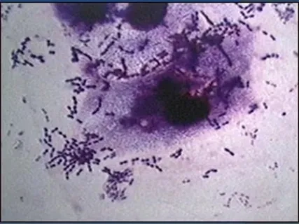 The invasive pneumococcal disease vaccine