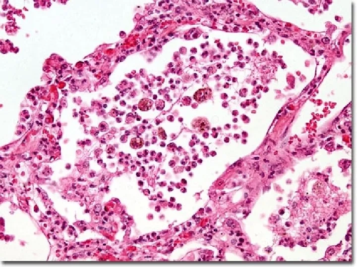A simple pneumonia disease description chart
