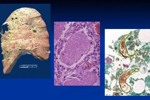 Explaining what is Pneumocystis pneumonia
