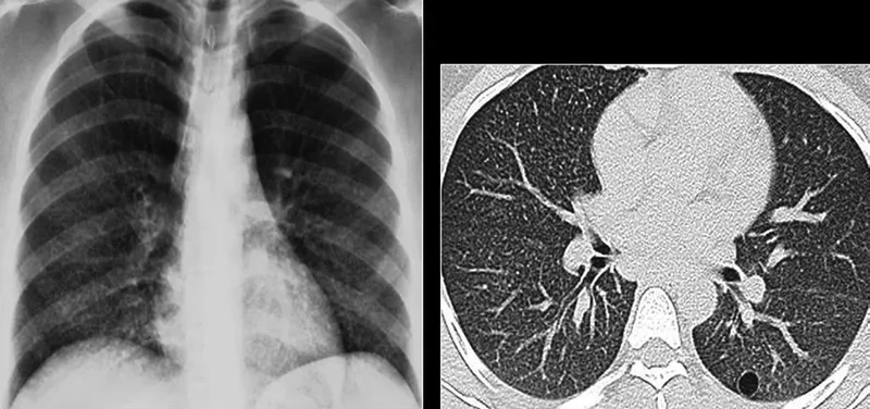 A microscopic view of Pneumocystis jirovecii