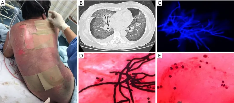 Recognizing Pneumocystis pneumonia (PCP) symptoms
