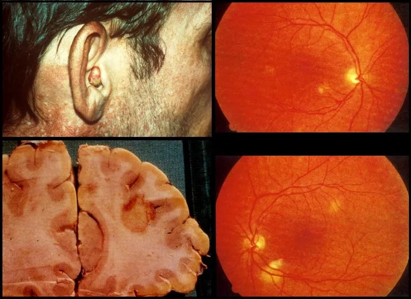 The importance of PCP prophylaxis for at-risk groups