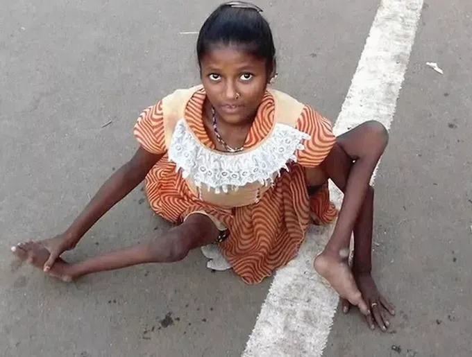 A microscopic illustration of the poliovirus