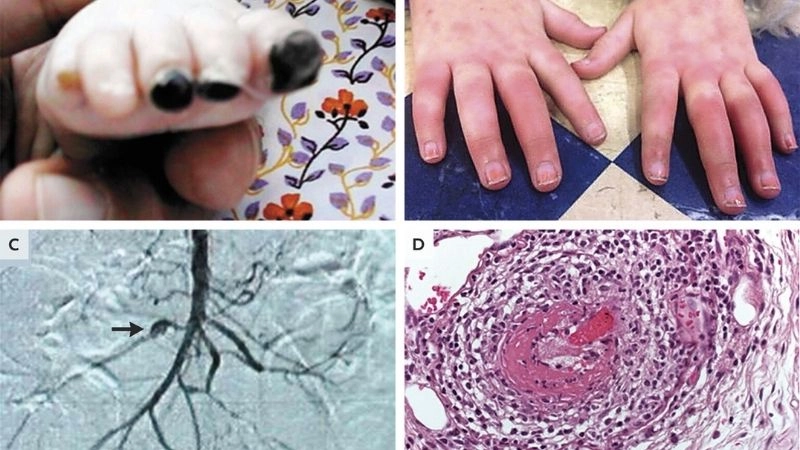 Polyarteritis Nodosa causes and risk associations