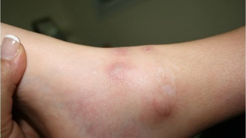 Polyarteritis Nodosa and hepatitis B strong link