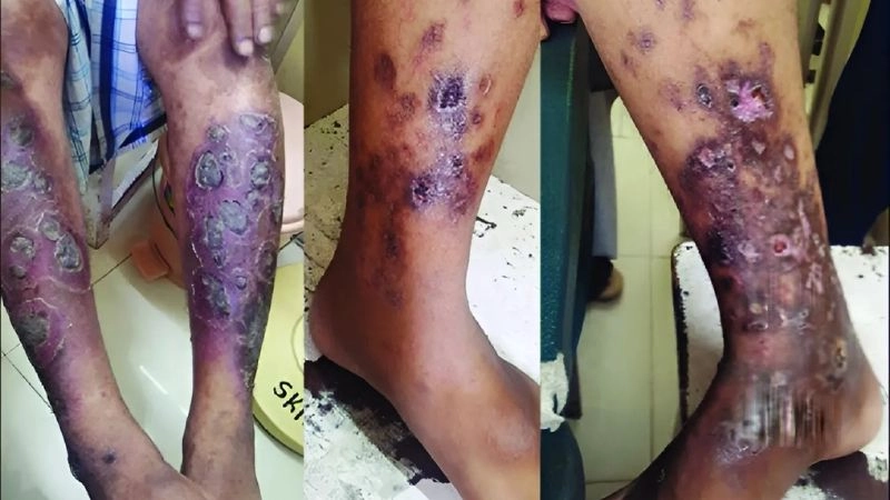 Polyarteritis Nodosa life expectancy and survival