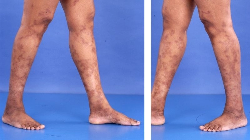 Polyarteritis Nodosa and nerve damage complications