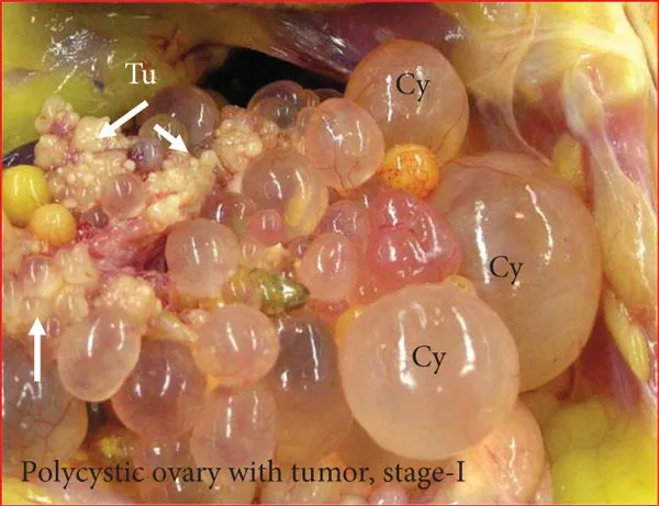 Prescription bottle of metformin for PCOS