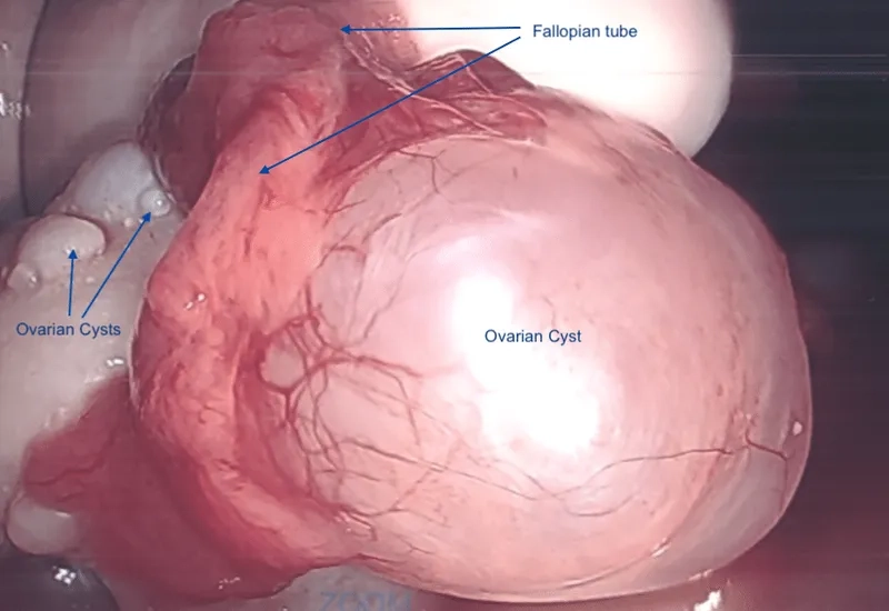 Tips on how to lose weight with PCOS