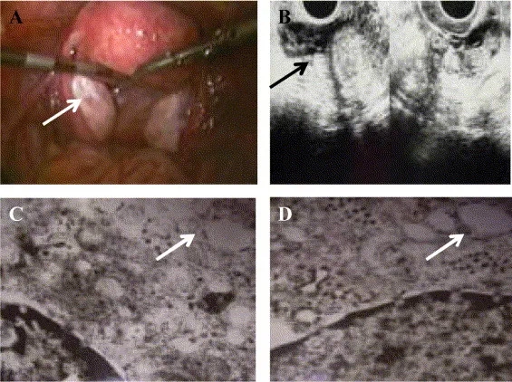 Medical options for PCOS treatment