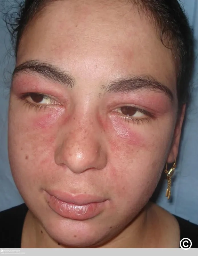 A visual guide to managing inflammatory myopathy