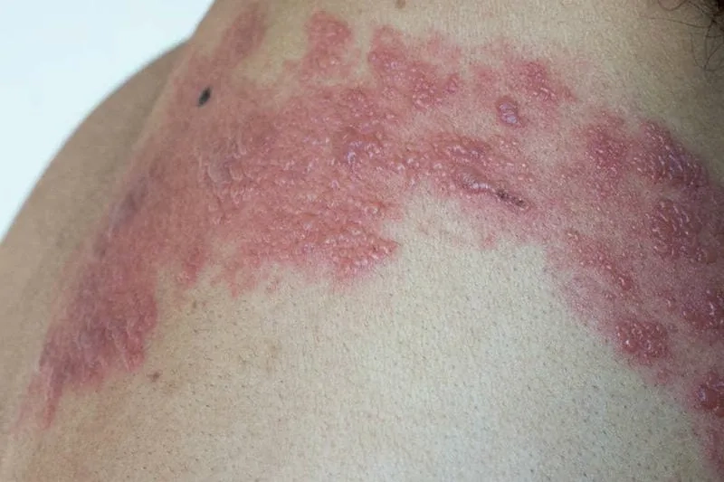 A guide to managing chronic shingles pain