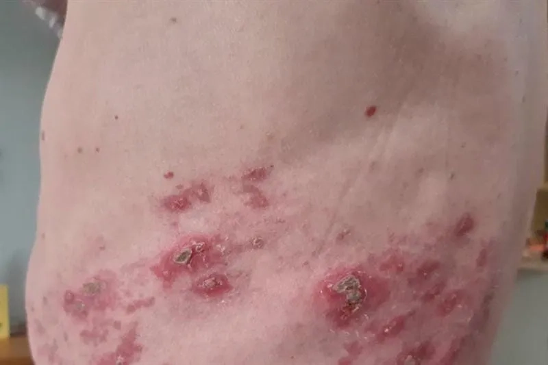 A diagram of nerve damage after a shingles infection