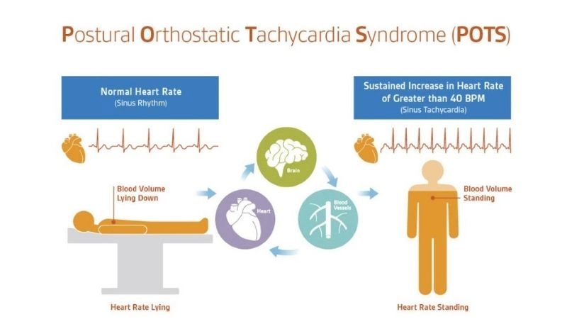 POTS Treatment helps manage irregular heart response