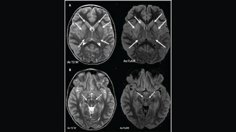 Learn safe ways for Powassan virus treatment today