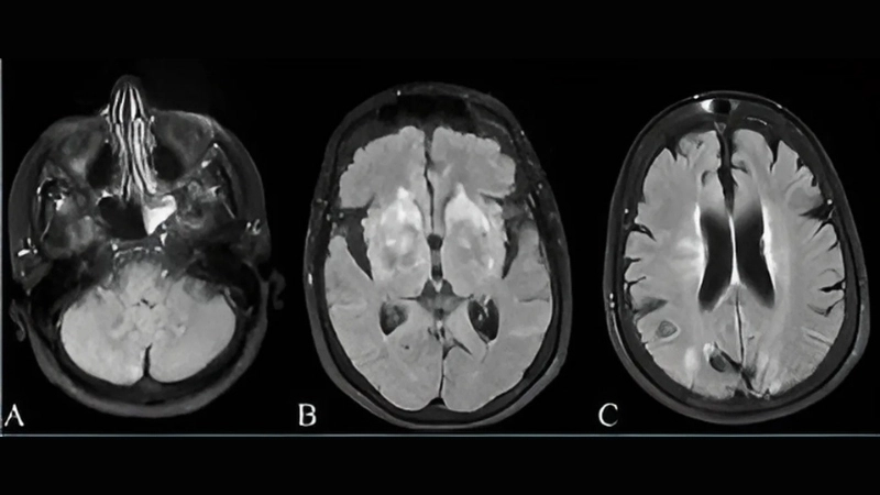 Updates on Powassan virus vaccine progress worldwide