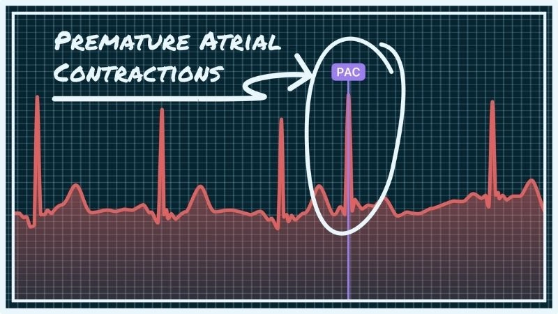 Premature atrial contractions treatment focuses on managing triggers