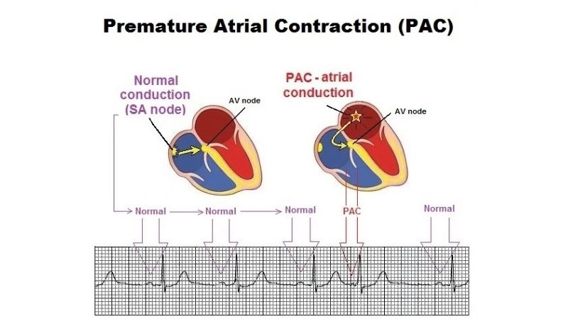 PAC and anxiety can worsen palpitations and racing sensations