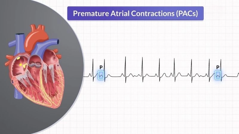 PAC heart palpitations feel sudden and irregular in the chest