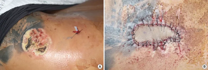 Dental X-ray showing a dental abscess Prevotella