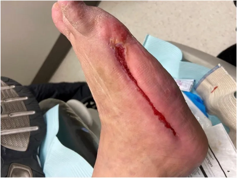 A chest scan indicating signs of aspiration pneumonia