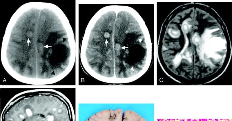 A medical chart of primary amebic meningoencephalitis (PAM)