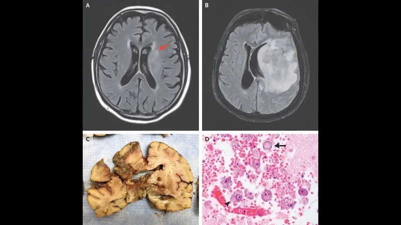 An illustration of the brain-eating amoeba in the body