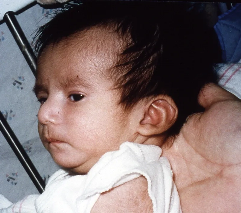 Laboratory research model of SCID immune disorder