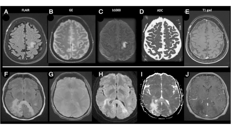 Natalizumab PML risk requires regular MRI monitoring
