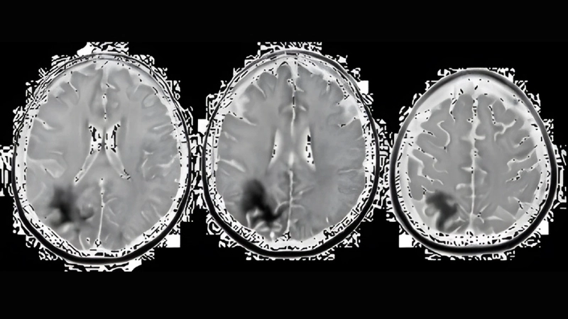 PML diagnosis relies on MRI and JC virus detection
