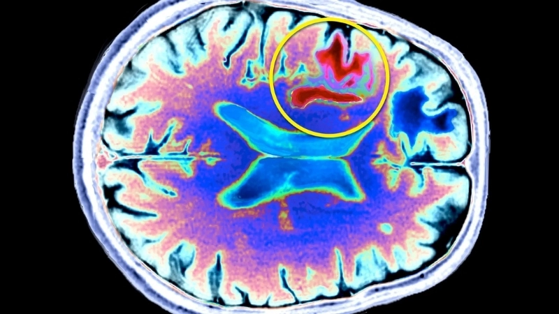 JC virus infection can trigger Progressive multifocal leukoencephalopathy