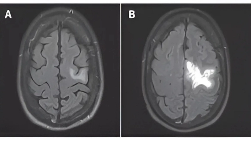 PML AIDS patients face higher risk of rapid brain damage