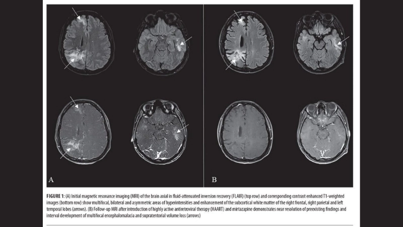 PML rituximab use may elevate susceptibility in immunocompromised