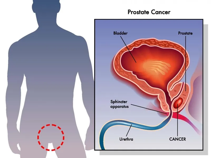 Understanding the Gleason score for prostate cancer
