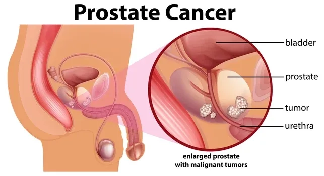 Chart showing the prostate cancer survival rate by stage