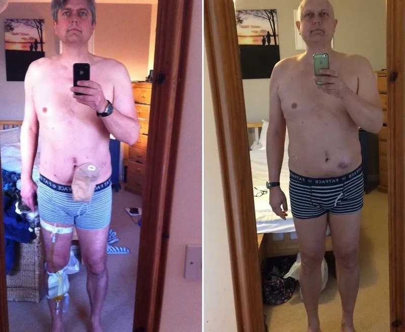 An infographic illustrating the prostate cancer stages