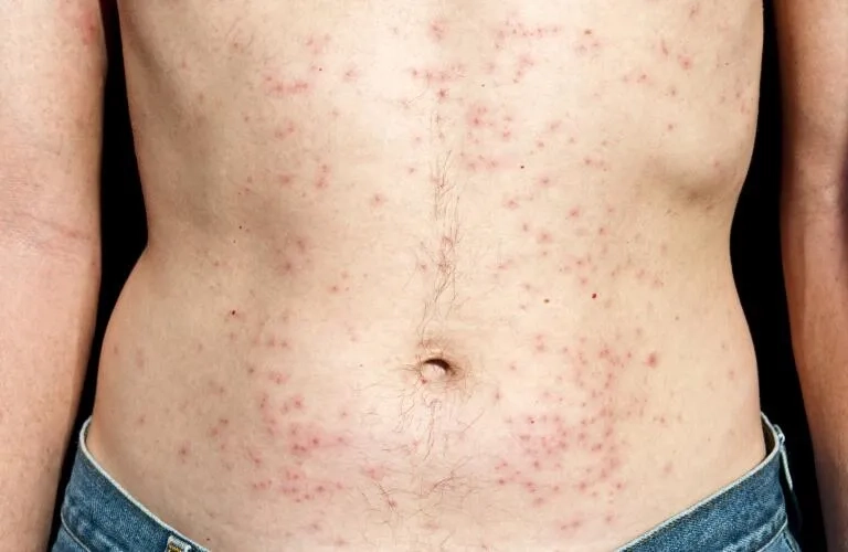 Understanding if Pseudomonas is contagious