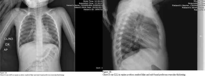 A chart detailing psittacosis human symptoms