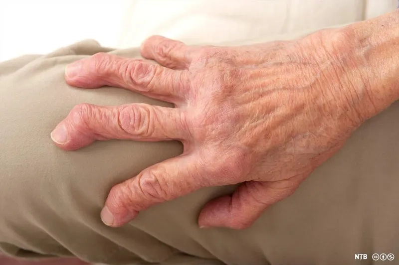 Comparing psoriatic vs rheumatoid arthritis