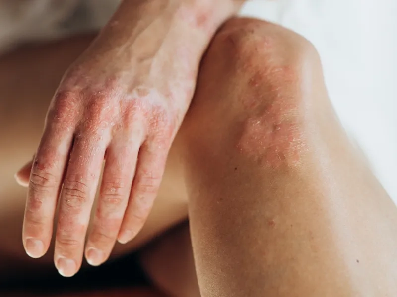 A vial of biologics for psoriatic arthritis