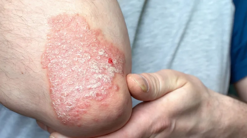 A psoriatic arthritis rash on the skin