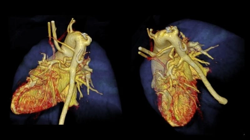 Pulmonary atresia and pregnancy important considerations
