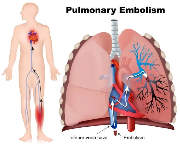 A medical team discussing pulmonary embolism treatment