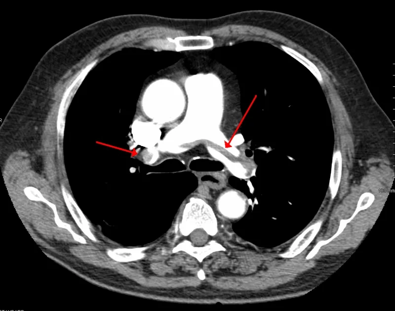 An infographic explaining the causes of pulmonary embolism