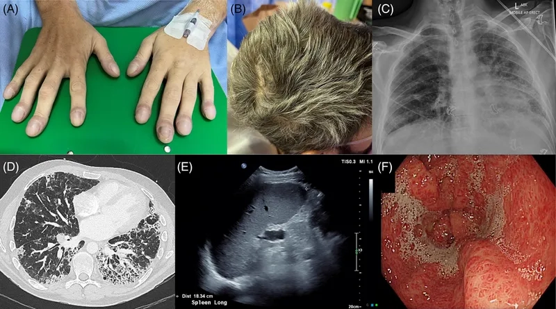 Research article on causes of pulmonary fibrosis